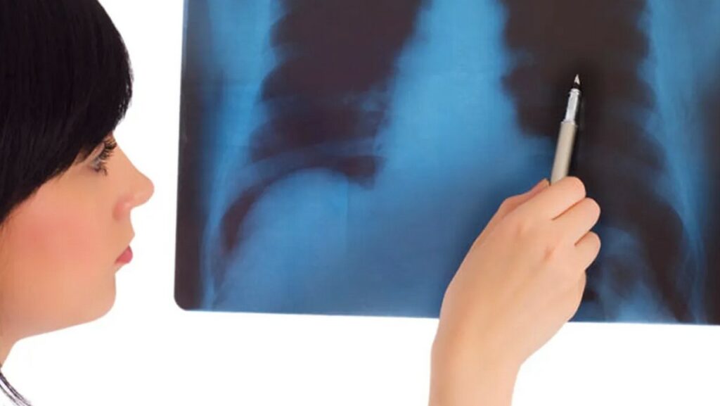 crestere-alarmanta-de-cazuri-de-osteoporoza-la-femeile-tinere.-preventie-si-recomandari